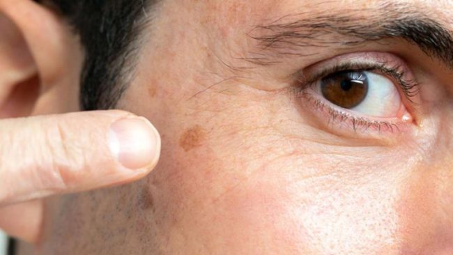 Age Spot Removal
