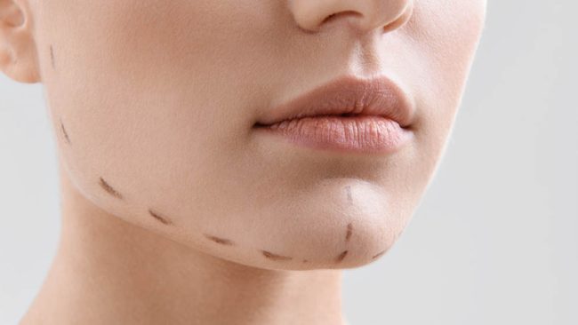 Chin Reduction Surgery