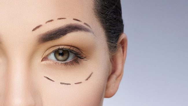 Eyelid Lift