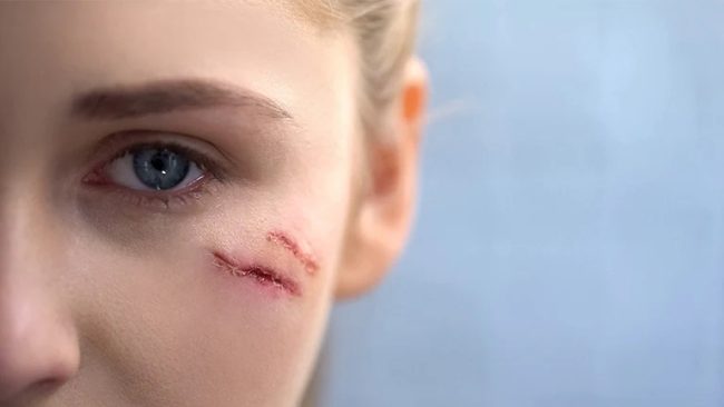 Facial Scar Revision