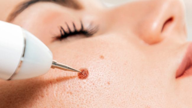 Facial Skin Lesion Removal