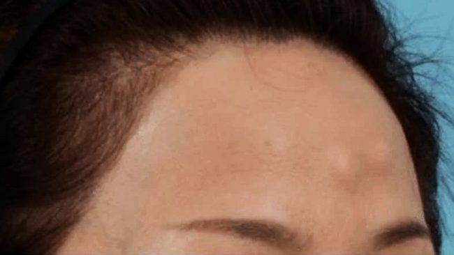 Forehead Osteoma Removal