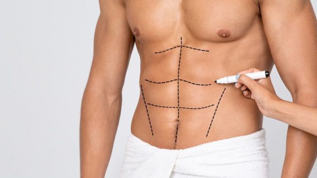 Male Liposuction