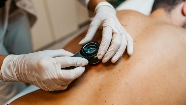 Seborrhoeic Keratosis Removal