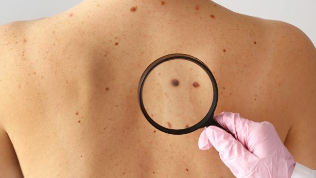 Skin Cancer Screening