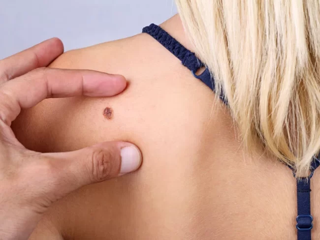 Skin-Lesion-Removal-London
