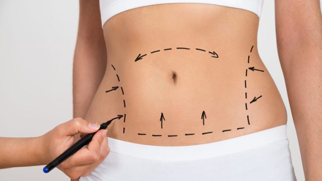 Stomach Liposuction