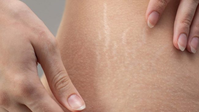 Stretch Mark Removal