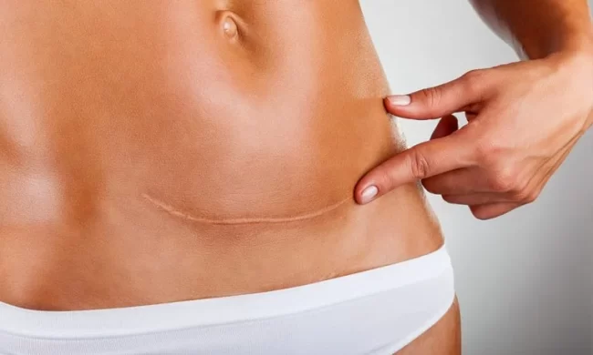 caesarean-section-scar-revision-london-768×461