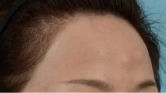 forehead-osteoma-removal-768×433