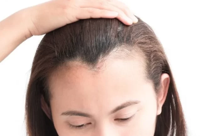 hairline-lowering-london-1-768×515