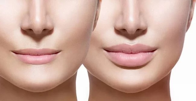 lip-fillers1-1024×527