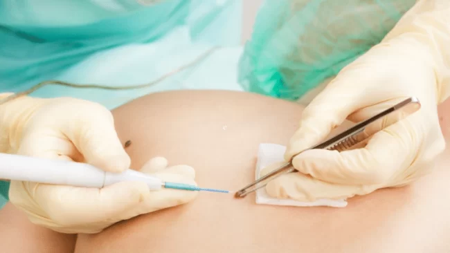 skin-cancer-surgery-london-uk-768×433