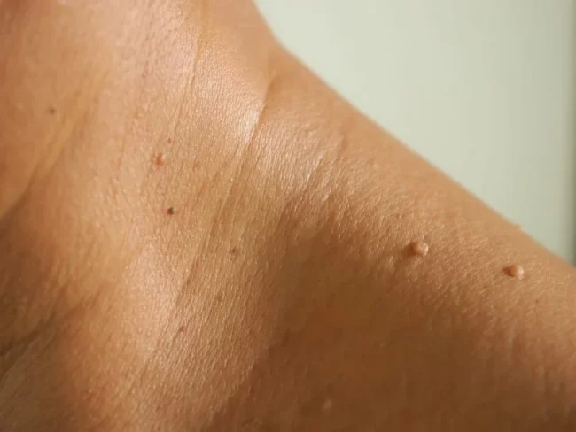 skin-tag-removal-london-768×576
