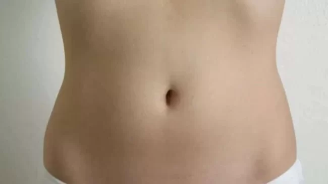 umbilicoplasty-1-768×432