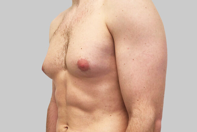 التثدي عند الرجال