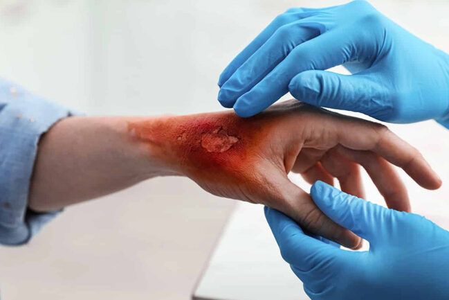 علاج الحروق في مركز A1 للجراحة يضمن لك استعادة مظهر الجلد الطبيعي باستخدام أحدث التقنيات الطبية المتقدمة لتحقيق أفضل النتائج